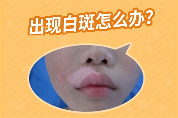 亳州早期白癜風要怎么治療